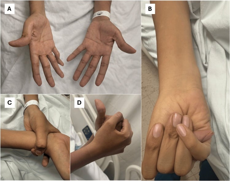 Hands demonstrating arachnodactyly, the Steinberg thumb sign and the Walker-Murdoch wrist sign.