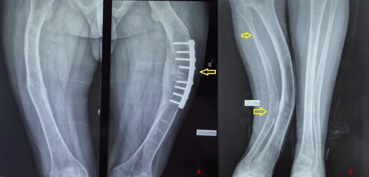 Lower-limb radiographs showing severe long-bone bowing and previous fixation in osteogenesis imperfecta.
