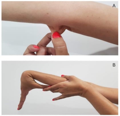 Cropped clinical figure showing forearm skin hyperextensibility and passive thumb-to-forearm apposition.