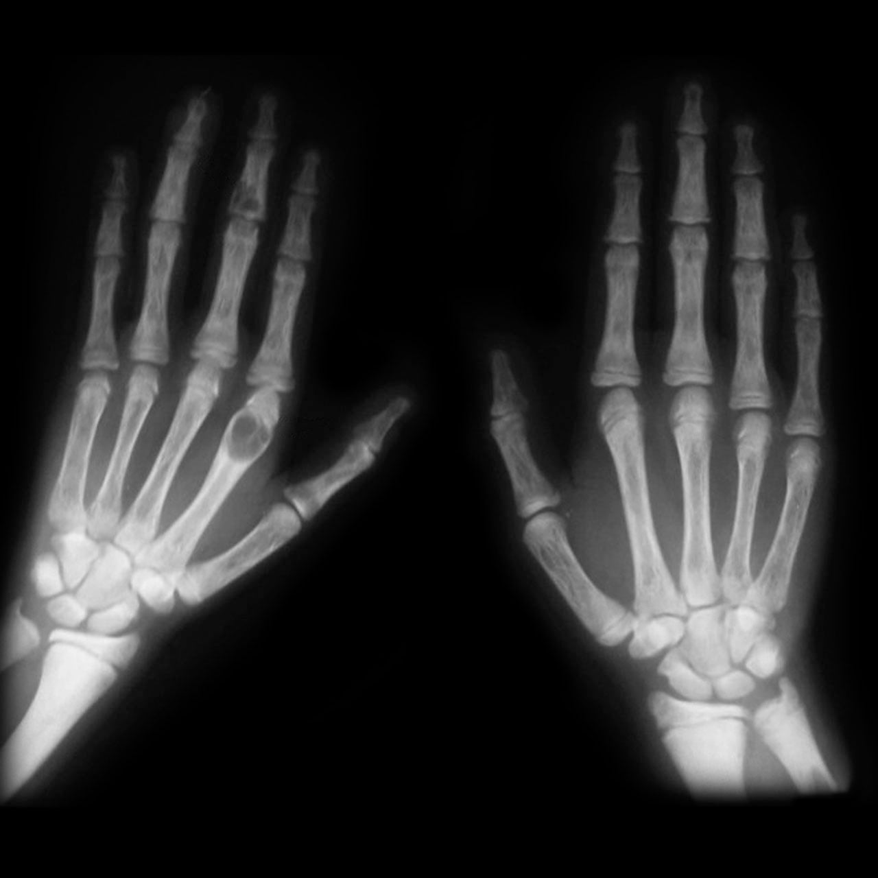 Radiographs of both hands showing lytic brown tumours in hyperparathyroidism.