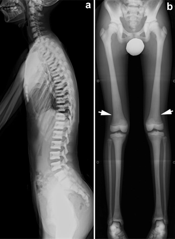 Radiographs showing generalised osteopetrosis with poor corticomedullary differentiation and Erlenmeyer flask deformity.