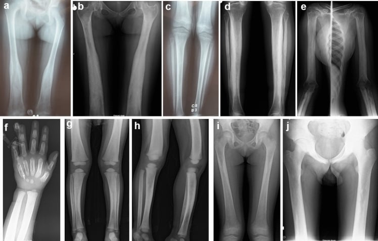 Serial radiographs showing progressive diaphyseal sclerosis in Camurati-Engelmann disease.