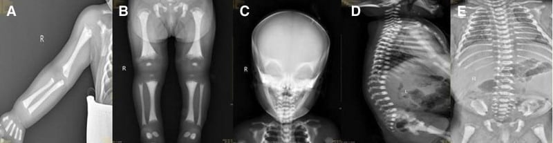 Skeletal survey showing diffuse increased density in the upper and lower limbs, pelvis, skull, spine and ribs.