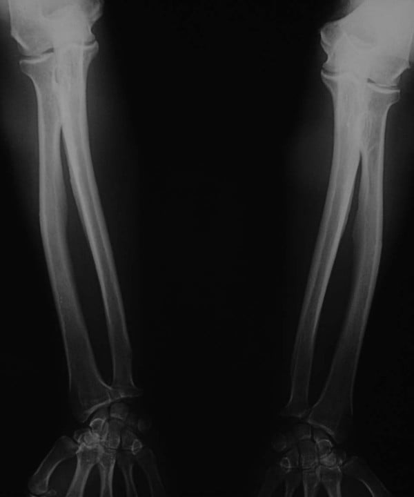 Forearm radiograph showing bilateral interosseous membrane ossification in skeletal fluorosis.