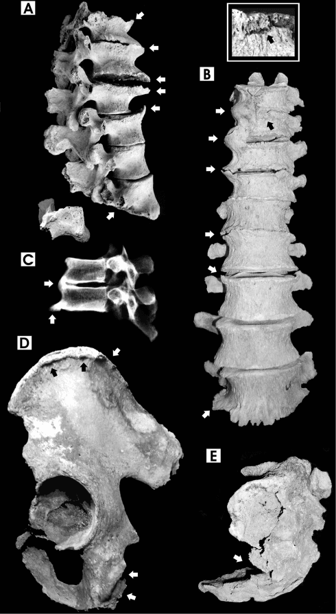 Gross skeletal specimens showing fluorosis-related osteosclerosis and ligamentous calcification.