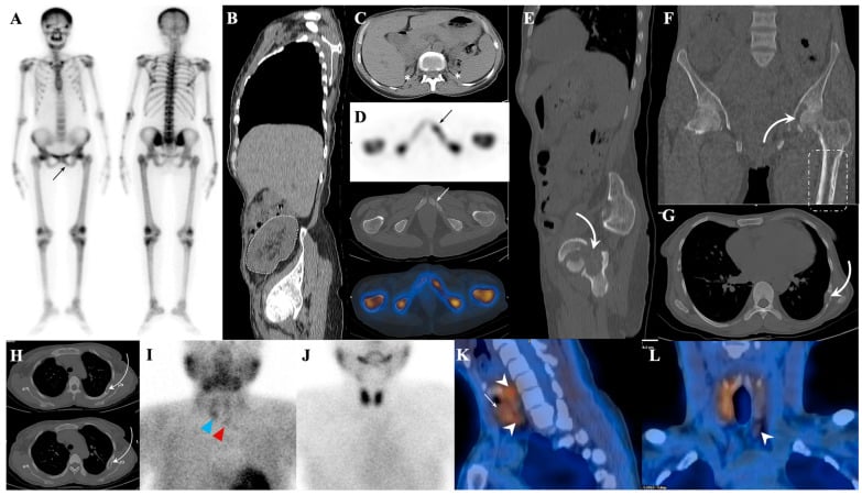 Bone scintigraphy and CT showing a metabolic superscan in a renal transplant recipient.