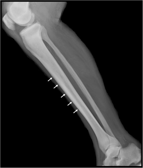 Lateral long-bone radiograph showing endosteal sclerosis in primary myelofibrosis.