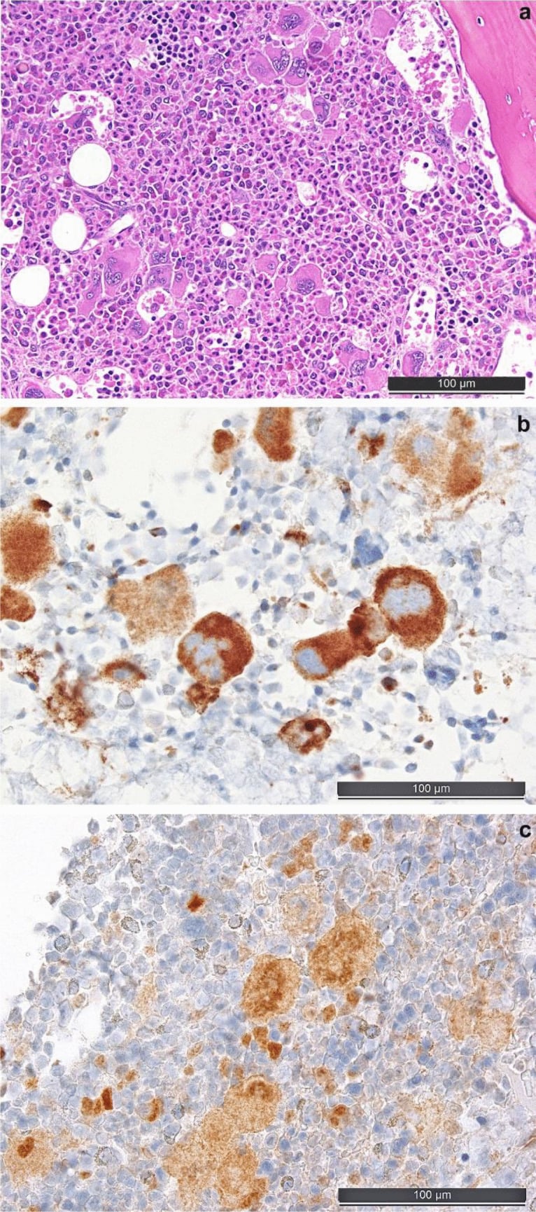Bone marrow trephine showing prefibrotic primary myelofibrosis with CALR and phospho-STAT5 staining.
