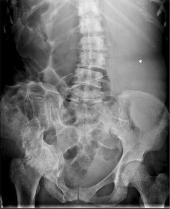 Abdominal radiograph showing diffuse axial osteosclerosis and massive splenomegaly.