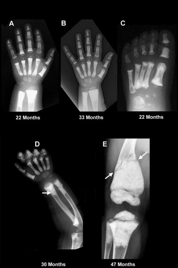 Serial hand and foot radiographs showing metaphyseal-predominant sclerosis in osteopetrosis.