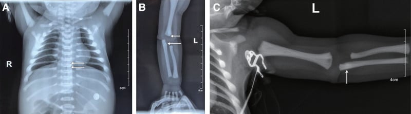 Radiographs showing sandwich vertebrae and bone-within-bone appearance in osteopetrosis.
