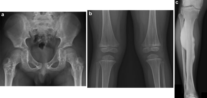 Radiographs comparing osteopoikilosis, osteopathia striata and melorheostosis.