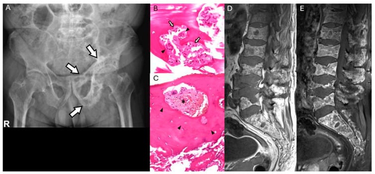 Pelvic radiograph and histology showing Paget disease with cortical and trabecular thickening.