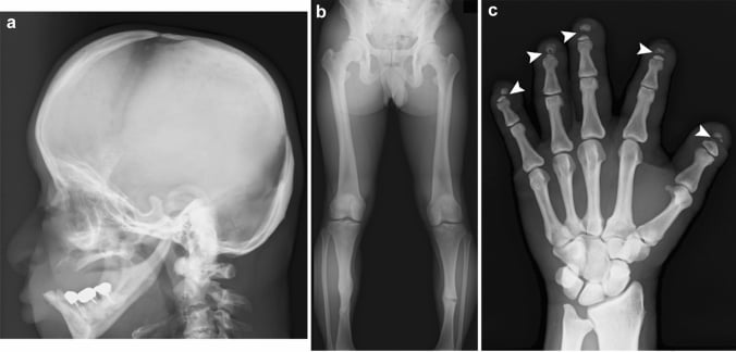Radiographs showing pyknodysostosis with skull sclerosis, open sutures and acro-osteolysis.