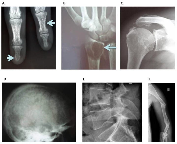Radiographic montage of chronic kidney disease mineral and bone disorder.