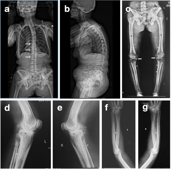 Spine and lower-limb radiographs showing skeletal fluorosis with ligamentous calcification.
