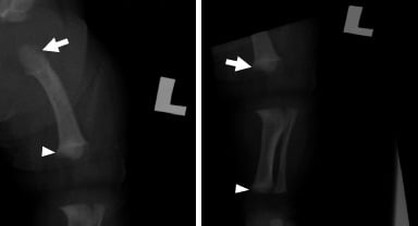 AP radiographs of a left femur and tibia showing rhizomelic shortening, proximal femoral lucency and metaphyseal cupping