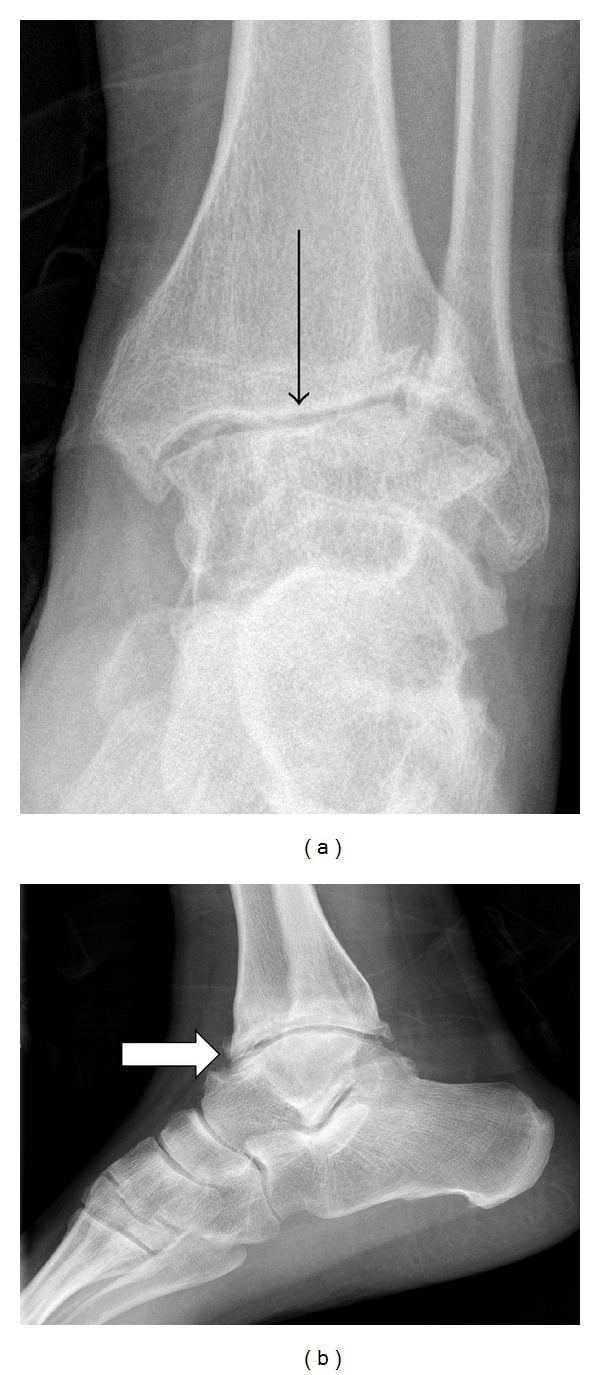 AP and lateral ankle radiographs showing tibiotalar joint-space loss in haemophilic arthropathy
