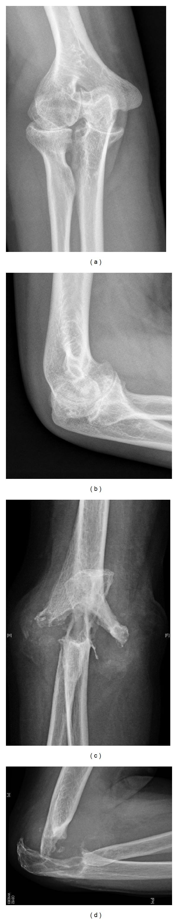 Serial AP and lateral elbow radiographs showing progressive haemophilic arthropathy then radial-head excision