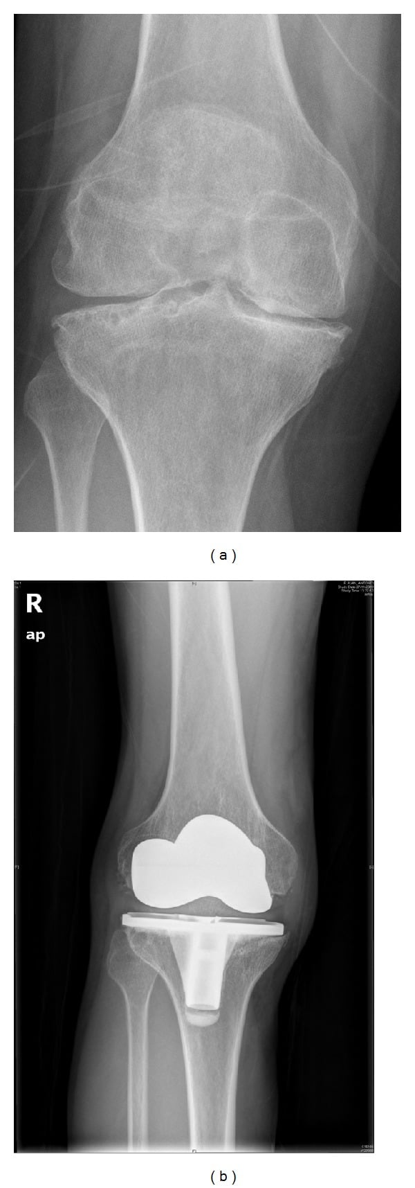 AP knee radiograph of end-stage haemophilic arthropathy beside a postoperative TKA radiograph