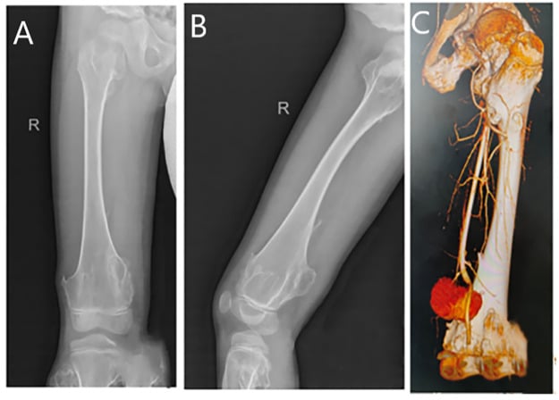 AP and lateral radiographs of a pedunculated distal-femoral osteochondroma with CT angiography of a femoral-artery pseudoaneurysm