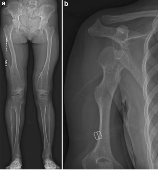 Radiographs of multiple long-bone osteochondromas with corticomedullary continuity and a sessile proximal-humeral osteochondroma