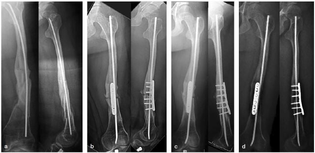 Four-panel femoral radiographs of osteogenesis imperfecta type III: bowed femur around a flexible nail, then osteotomy, plate and later union