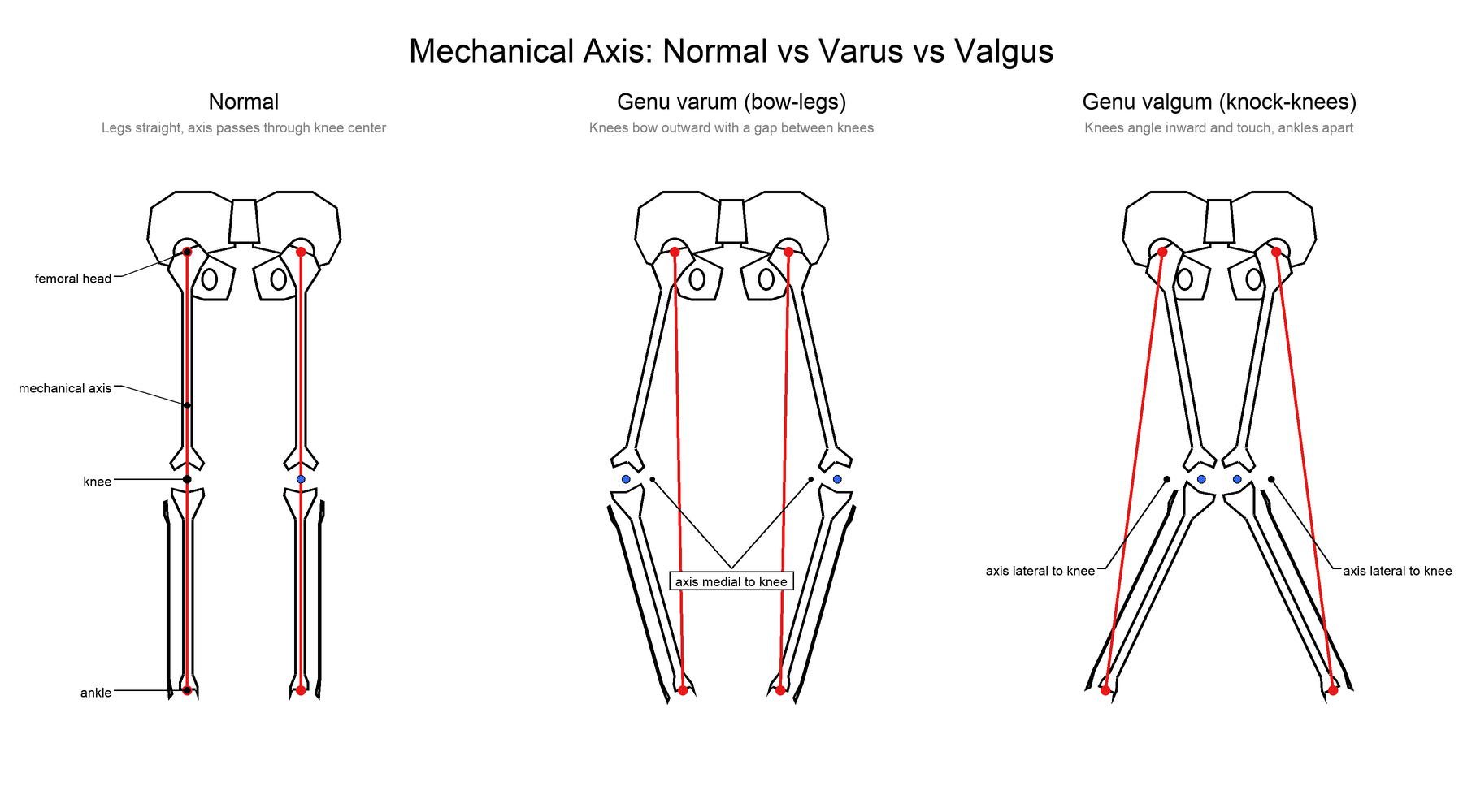 Diagram of the lower-limb mechanical axis in normal, genu varum and genu valgum alignment