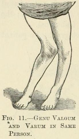 Historical illustration contrasting genu valgum (knock-knee) and genu varum (bow-leg) in the same person — the two coronal-plane knee malalignments.
