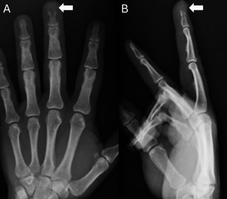 Posteroanterior and lateral radiographs of the hand showing an erosive lesion at the tuft of a distal phalanx