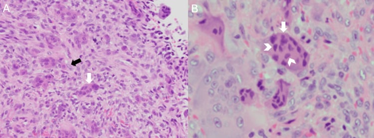 H&E histology showing an abundance of multinucleated osteoclast-like giant cells at low and high power