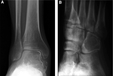 Radiographs showing giant cell tumours of the talus and cuboid