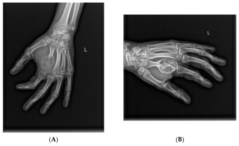 Surgical treatment sequence of a distal femoral giant cell tumour before denosumab, after six doses and after curettage with PMMA cement