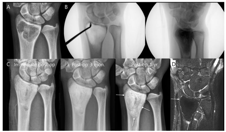 Distal radius giant cell tumour before curettage, during cementation and on serial postoperative radiographs and MRI