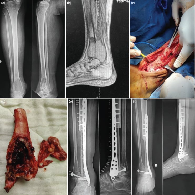 Distal tibial giant cell tumour shown on radiograph, MRI, resection specimen and postoperative ankle arthrodesis