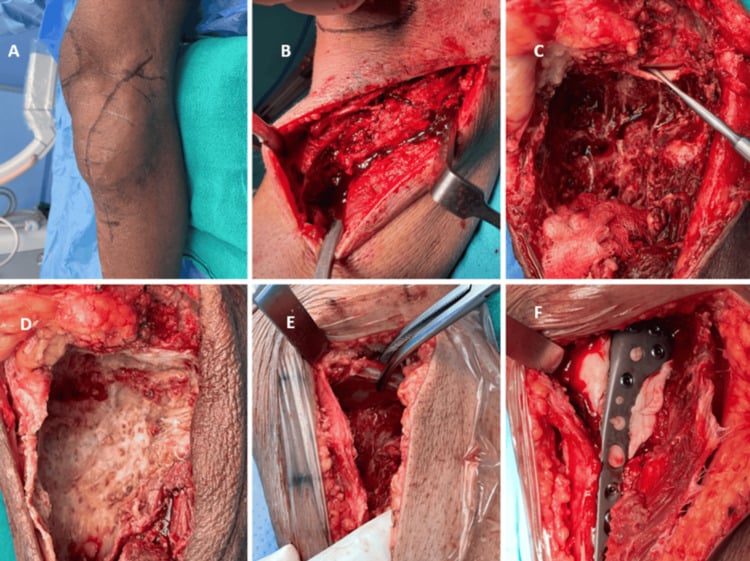 Extended curettage of a proximal tibial giant cell tumour with subchondral graft, cement and plate reconstruction