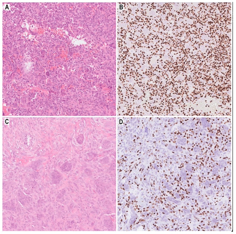 H&E and H3.3 G34W immunohistochemistry in giant cell tumour of bone