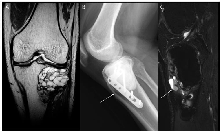 Local-recurrence complication after giant cell tumour curettage and cementation on radiograph and MRI