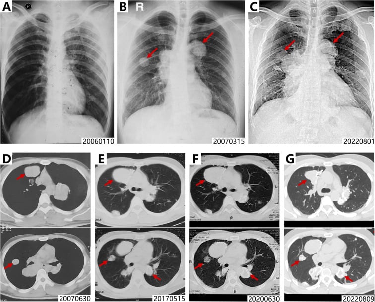 Pulmonary-metastasis complication of giant cell tumour shown on serial chest radiographs and CT