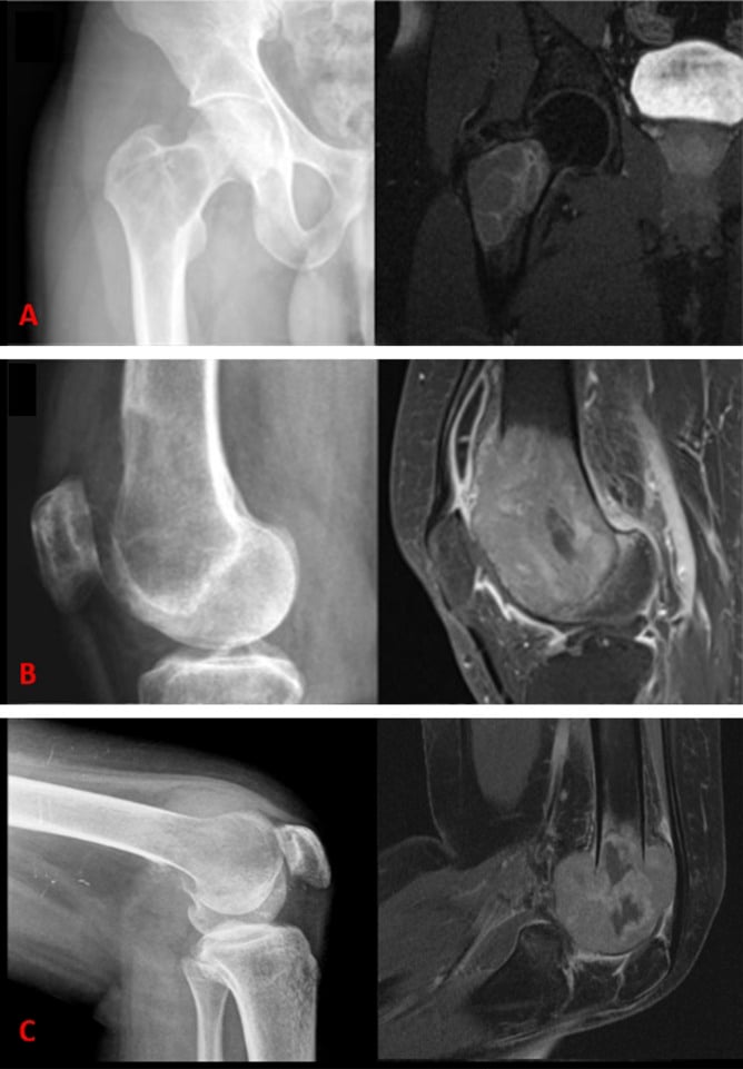 Paired radiographs and cross-sectional images showing three grades of giant cell tumour of bone
