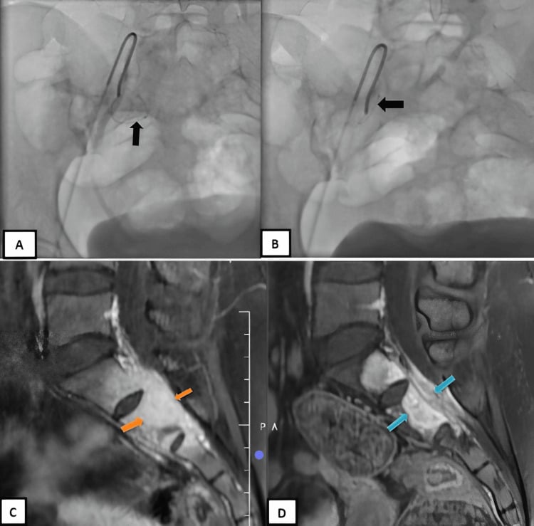 Selective internal iliac branch embolization and MRI response assessment in sacral giant cell tumour