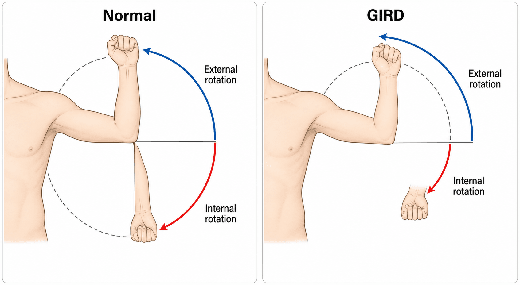 Clinical examination schematic comparing internal and external rotation arcs in a normal shoulder and a shoulder with GIRD
