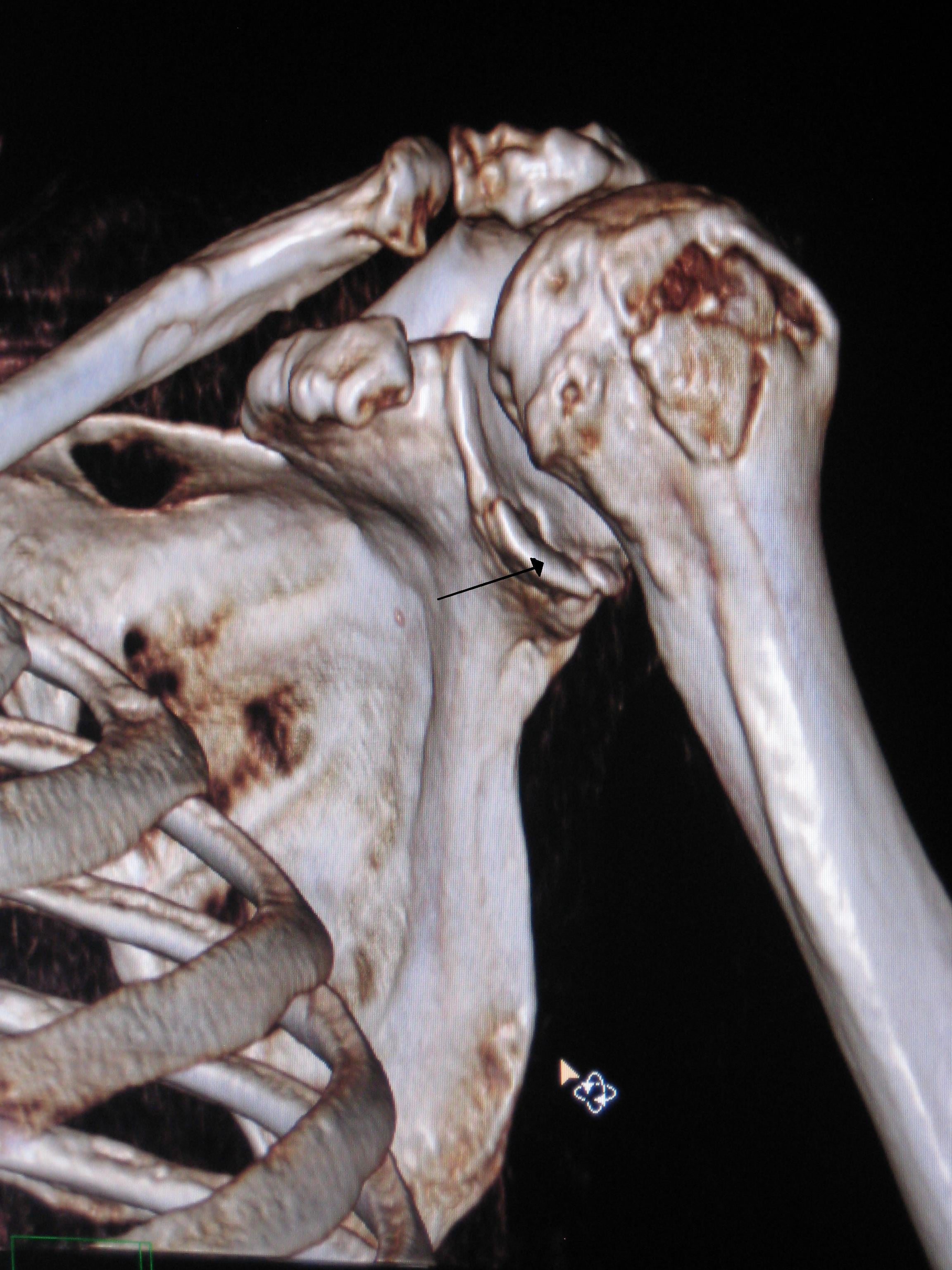 3D CT of the glenohumeral joint after anterior dislocation, with a bony Bankart fragment at the anteroinferior glenoid and mild superior humeral subluxation