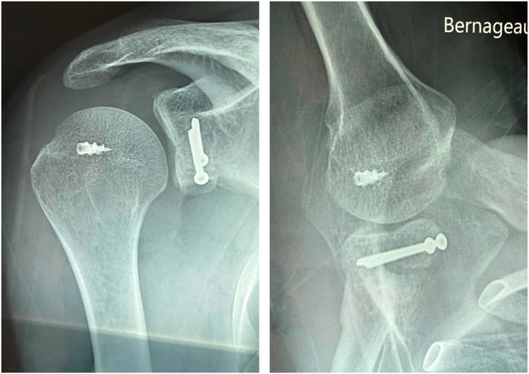 Postoperative AP and axillary radiographs after anterior glenoid bone block combined with Hill-Sachs remplissage