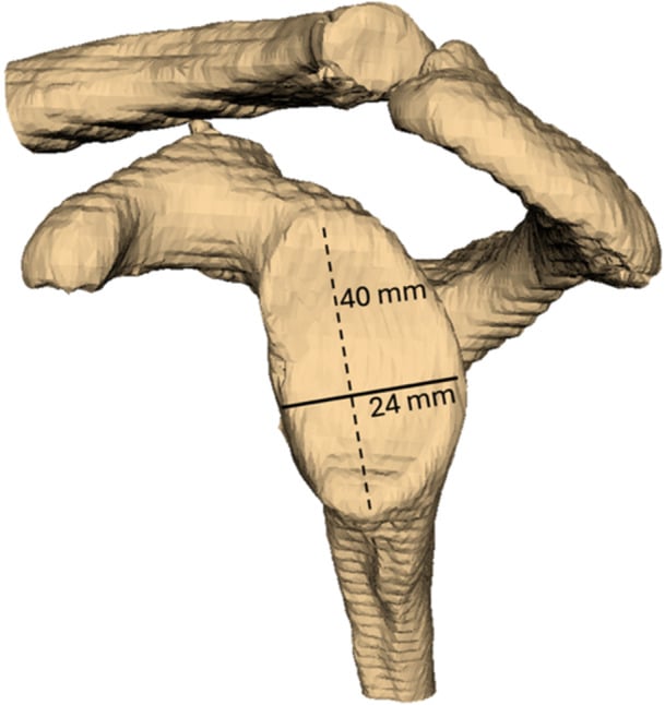 En-face 3D CT of the glenoid with superior-inferior and anterior-posterior linear measurements used to estimate width loss