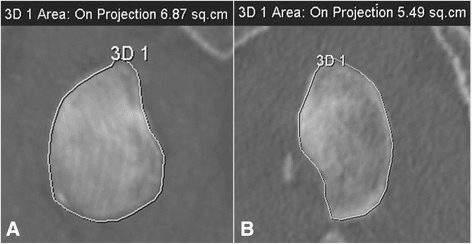 Paired CT reconstructions comparing the intact contralateral glenoid surface area with the deficient glenoid surface area