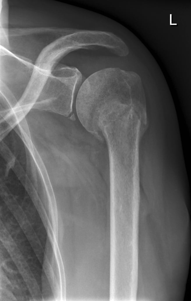 AP shoulder radiograph showing a small bony fragment at the inferior glenoid (bony Bankart)
