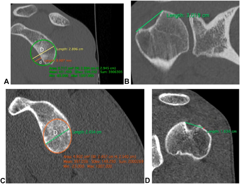 Four-panel CT: off-track Hill-Sachs with glenoid-track and Hill-Sachs-interval overlays versus an on-track lesion