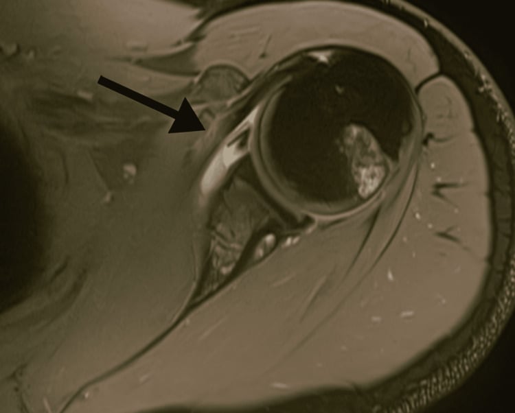 Axial MRI of the humeral head showing a large posterolateral Hill-Sachs impaction with the glenoid en face