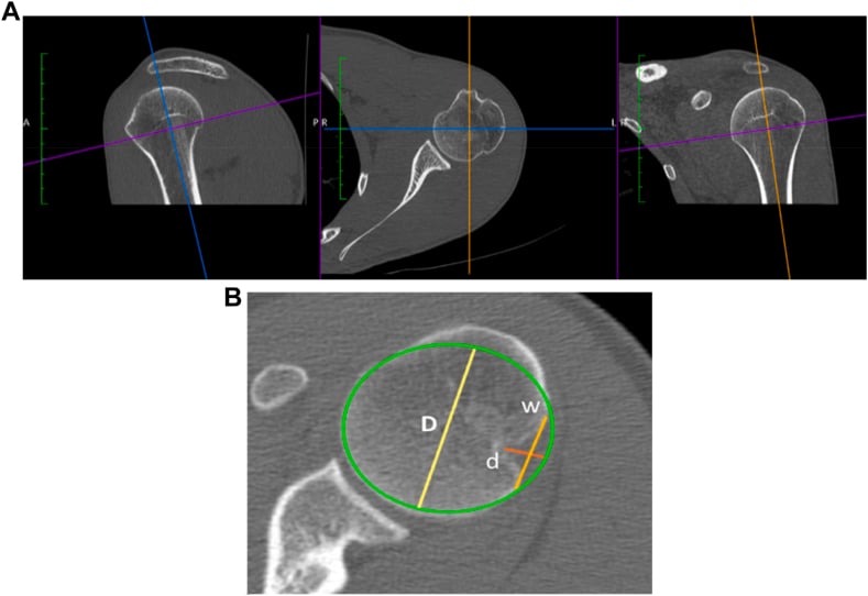 Axial CT of the humeral head with a best-fit circle used to measure Hill-Sachs depth and width